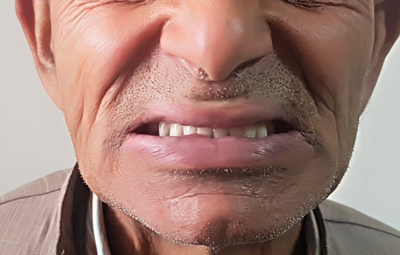 Patient wearing upper and lower denture (Artificial Teeth)