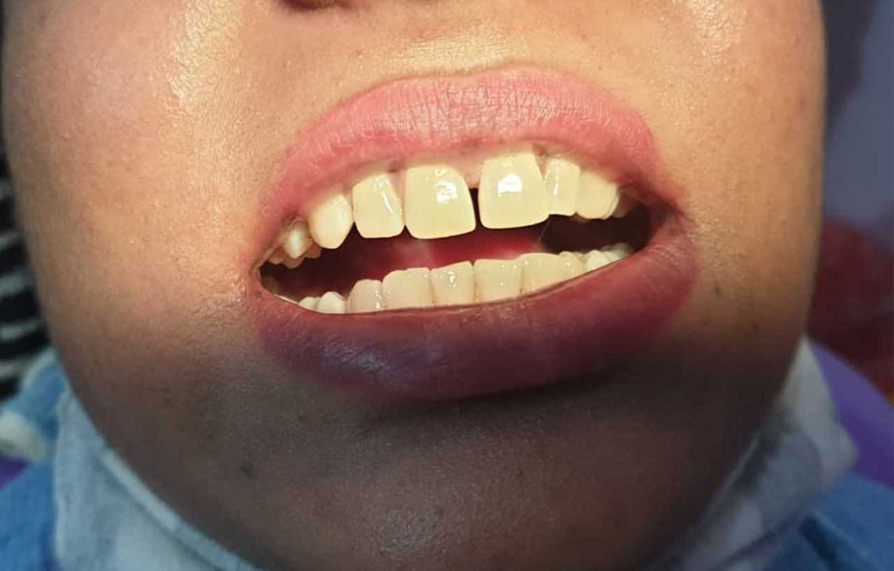 Space between front teeth